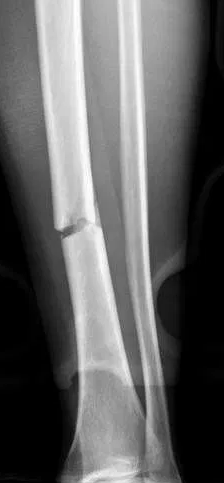 Fractura de tibia