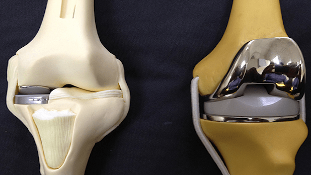 artroplastia de rodilla