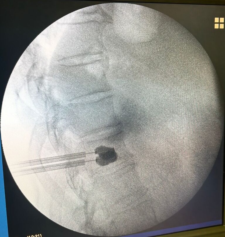 Cifoplastia